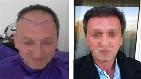 hermes hair transplant clinic reviews|hermest hair transplant reviews reddit.